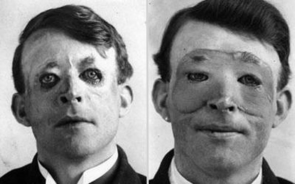 Одна из первых пластических операций по пересадке кожи, 1917г.