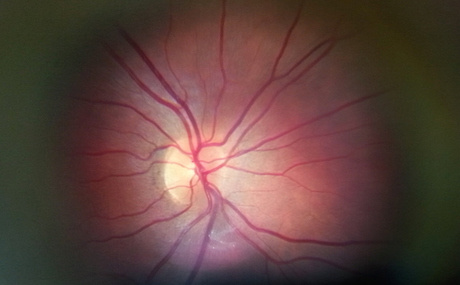 Этот снимок внутри глаза сделан с помощью Peek Retina