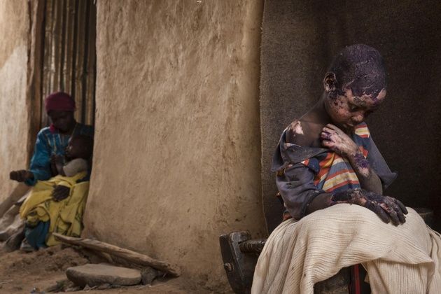 Номинация:  «Актуальные проблемы»
«Забытые горы Судана», Эдриен Оганесян (США)

Семилетний Адам Абдель получил серьёзные ожоги после того, как рядом с его домом в Бургу (провинция Центральный Дарфур, Судан) разорвалась бомба